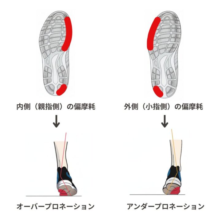 イラスト - アウトソールの偏摩耗パターン（かかと外側/親指内側）と対応する足の図解